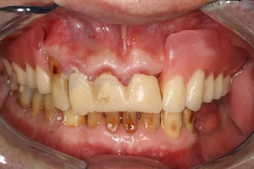 Figure 12 The wax-up denture try-in.