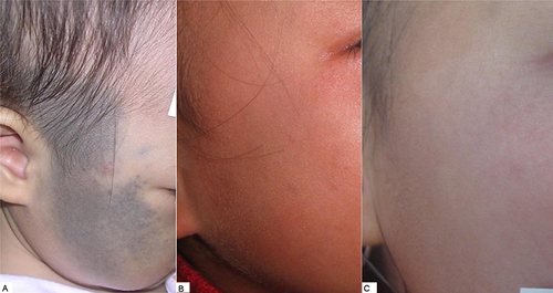 Figure 3 Follow-up process involved in the care of a typical patient. (A) Before treatment; (B) 6 months after the fourth treatment; (C) 3 years after the 5th treatment.
