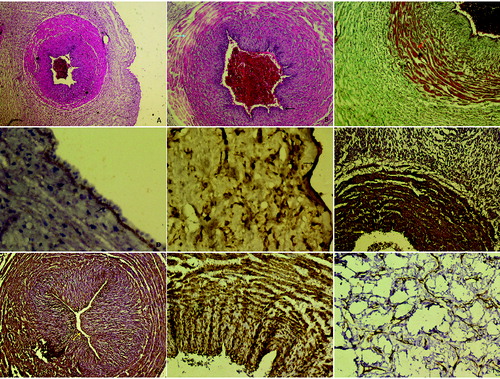 Figure 1. A: Control group, appearance normally of umbilical cord, H–E stain Bar 50 µm. B and C: HELLP group; degeneration of endothelial cell in the vessel wall (arrows), thickness in basal membrane, edema in the intermediate connective tissue between muscle layers (arrows), H–E stain Bar 100 µm, increase in collagen fibres between smooth muscle layers (arrow), Tichrom-Masson stain Bar 100 µm. D and E: Strong expression of MMP9 in basal membrane of vessel wall and amniotic epithelium (arrows). Also positive expression in Wharton's jelly. MMP9 immunohistochemistry staining Bar 100 µm. F and G: Positive expression in endothelial cells, basal membrane and fibroblast cells in HELLP group, CD44 immunohistochemistry staining Bar 50 µm. H and I: Positive reaction of actin protein in Wharton's jelly spindle-like fibroblast cells and smooth muscle layers. α-smooth muscle actin immunohistochemistry staining Bar 100 µm.