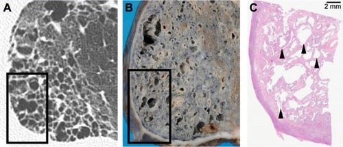 Figure 3 Computed tomography images and their corresponding histological images of right lower lobe.Notes: (A) Computed tomography image shows coarse reticulation with honeycomb-like clustered cystic airspaces. Squared area corresponds to microscopic observation (C). (B) A gross picture of the same lesion. Squared area corresponds to microscopic observation (C). (C) Microscopic observation revealed cystic spaces and interstitial fibrosis. Arrowheads indicate areas corresponding to honeycomb cysts.