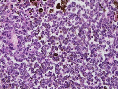 Figure 3 Detail of tumor melanoma cells that have an atypical nucleus. Note: Image courtesy of JL Kemeny.