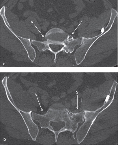 Figure 4. a. Bony encroachment of the left L5 nerve post-foraminally (E). The contralateral L5 is unaffected in its post-foraminal path (N). b. A few slices more distally. The left L5 is dislocated laterally from its anatomical path (D), running through the area with fracture sequelae, with topographical changes of the adjacent bony surface. (A) shows the unaffected contralateral L5 nerve running in its anatomic path.