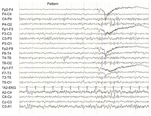 Figure 6 Pattern-induced focal epileptiform discharge.