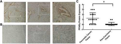 Figure 1 Expression of PPARγ in pancreatic cancer tissues and para-carcinoma tissues. Surgically resected human pancreatic adenocarcinomas were obtained, and the expression of PPARγ in (A) pancreatic cancer tissues and (B) para-carcinoma tissues was examined by immunohistochemistry. (C) Scoring for PPARγ expression in each section according to the degree of staining and the percentage of stained cells (n=18, *P < 0.01).