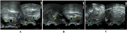 Figure 2 The ultrasonograms before the surgery. (A) 2 gestational sacs with 2 yolk sacs at the left adnexa; (B) Both ovaries were normal; (C) No gestational sac in the uterine cavity and the endometrial thickness was 9.5mm. The presence of approximately 9 × 8mm hypoechoic nodules between the anterior uterine wall muscles suggests the possibility of uterine fibroids.