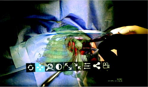 Figure 2. View from the headset during the surgical procedure.