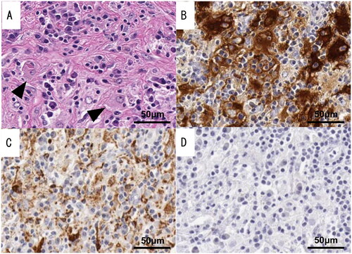 Figure 4. Pathological findings of resected specimens of case 2. The tissue shows a histological picture consisting of histiocytic infiltration with foamy histiocytes and diverse inflammatory cell infiltration. Emperipolesis, a process by which one cell engulfs and temporarily retains another cell within its cytoplasm, has been observed in immune cells, particularly macrophages (black triangles). The immunohistochemical analysis revealed positive staining for S-100 protein and CD68 but negative staining for CD1a. (A) Marked histiocytic infiltration. Emperipolesis was confirmed in a few histiocytes. (B) Immunohistochemical staining for S-100 protein. (C) Immunohistochemical staining for CD68. (D) Immunohistochemical staining for CD1a.