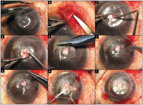 Figure 3. This figure illustrates the different steps of a tenon's patch graft. a) Creation of a conjunctival bleb with balanced salt solution b) Harvesting the graft from the inferotemporal quadrant c) Plugging of the graft within the margins of the perforation with a blunt instrument d) Securing the graft with fibrin glue e-g) Placement of vertical and horizontal infinity sutures h) Gentle maneuvering with an iris repositor to release the iris adhesion. The step is being carried out under air in the anterior chamber i) A tectonically stable globe noted at the end of the procedure with a mobile air bubble in the anterior chamber.