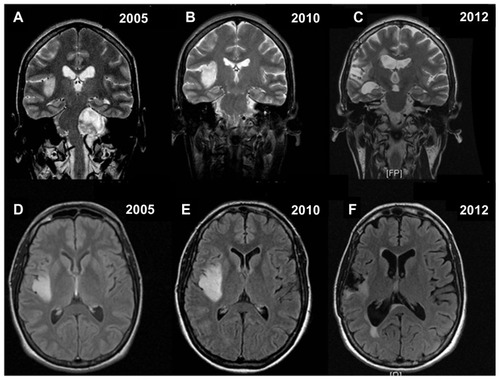 Figure 2 Coronal T2-weighted and axial flair magnetic resonance images confirming the findings of Figure 1 (A–F).