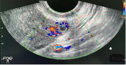 Figure 3 The blood flow pattern of the ectopic pregnancy mass.