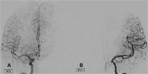 Figure 3 Coronal view of both ICAs via digital subtraction angiography three months after pipeline device implantation presenting left anterior cerebral artery hypoperfusion from left ICA (B) that is compensated via crossflow from right ICA (A).