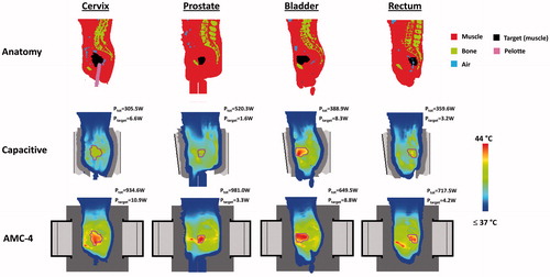 Figure 13. Sagittal slices of the simulated temperature distribution for small fatless cervix, prostate, bladder and rectum cancer patients heated with capacitive electrodes (25 + 25 cm) using overlay boluses or the radiative AMC-4 system. The maximum temperature in all distributions is 44 °C. The total power absorbed in the patient (Ptot) and in the target region (Ptarget) is indicated for each distribution. Slices were taken approximately through the centre of the patient. The contour in the temperature distributions indicates the target region.
