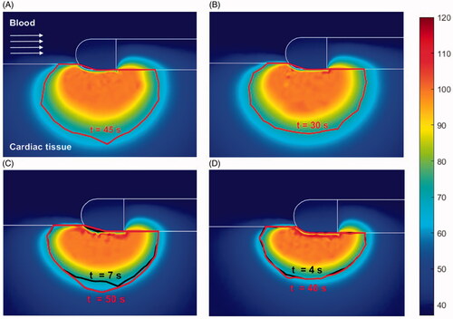 Figure 6. Temperature distribution (°C) and thermal lesions created in cardiac tissue with the catheter in the parallel orientation by a standard ablation protocol of 20 W–45 s (A) and 30 W–30 s (B), and also a HP-SD ablation protocol of 70 W–7 s (C) and 90 W–4 s (D). The thermal lesion was assessed by the Arrhenius contour Ω = 1 at the end RF ablation time (red solid line in A and B and black solid line in C and D together with the ablation time) and after the extra thermal expansion caused by thermal latency in the cooling period (red solid line in C and D together with the minimum time required to reach it).
