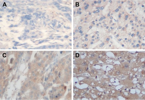 Figure 1 Immunohistochemistry of RACO-1 expression in HBV-related HCC tissues.