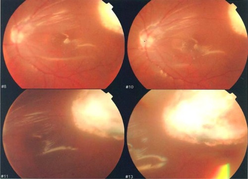 Figure 4 Postoperative view, showing a peripheral exit.