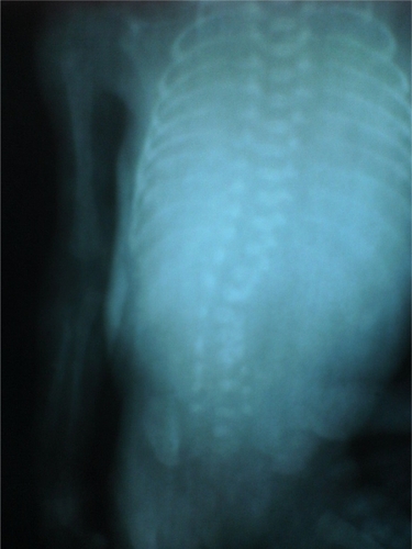Figure 5 Post mortem plain radiograph of the spine shows lumbar hemivertebra.
