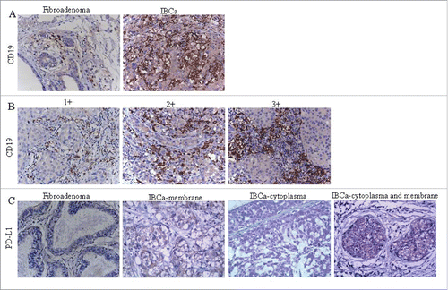 Figure 1. Immunochistochemical staining of CD19 and PD-L1 in IBCa and fibroadenoma tissue of breast. Sections of fibroadenoma tissues and IBCa were stained with anti-CD19, anti-PD-1 and anti-PD-L1 antibodies, as described in “Materials and Methods”, shown in Fig. 1 are representative microphotographs (× 400). (A) The density of CD19+ B lymphocytes is significantly higher in IBCa tissue than that in fibroadenomas of breast. (B) The density of CD19+ B lymphocytes in grade 1, 2 and 3 IBCa. C: PD-L1 is strongly expressed in the cell membrane, cytoplasm or both the IBCa tissues than that in fibroadenomas of the breast. Isotype-matched mouse IgG1 mAb was used as control.