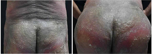 Figure 4 The erythema infiltration of the buttocks was aggravated, and part of the skin was pink and the pain was severe.