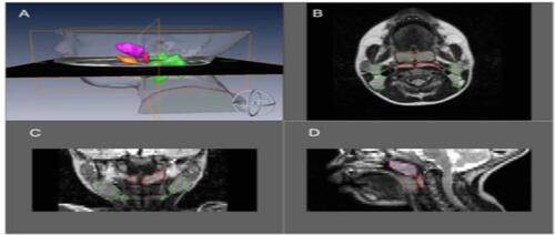 Figure S12 MRI volumetric analysis of lymphoid tissue volumes in an OSA patient (green-upper jugular lymph nodes, orange-tonsil tissue, red-retropharyngeal lymph nodes, magenta-adenoid tissue). (A) Three dimensional reconstruction of lymphoid tissue using Amira® software. (B) Axial T2-weighted DICOM image with lymphoid tissue tracings. (C) Coronal T2-weighted DICOM image with lymphoid tissue tracings. (D) Sagittal T2-weighted DICOM image with lymphoid tissue tracings.Note: Nandalike K, Shifteh K, Sin S, Strauss T, Stakofsky A, Gonik N et al., Adenotonsillectomy in obese children with obstructive sleep apnoea syndrome: magnetic resonance imaging findings and considerations, SLEEP, 2013, 36, 6, 841-847, by permission of Oxford University Press.Citation146