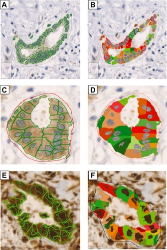 Figure 3 HistoQUEST (TissueGnostics) expression analysis. Pictures A, C, and E represent the identification and segmentation of cells and nuclei. Pictures B, D, and F demonstrate the diaminobenzidine signal intensity for each cell in the studied area.