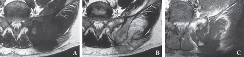 Figure 5.  Case 2. (A) MRI showed a low-intense lesion around the left sacroiliac joint on T1-weighted images. (B) T2-weighed images confirmed a heterogenous hyperintense lesion. (C) The lesion was enhanced on fat-suppressed T1-weighed images.