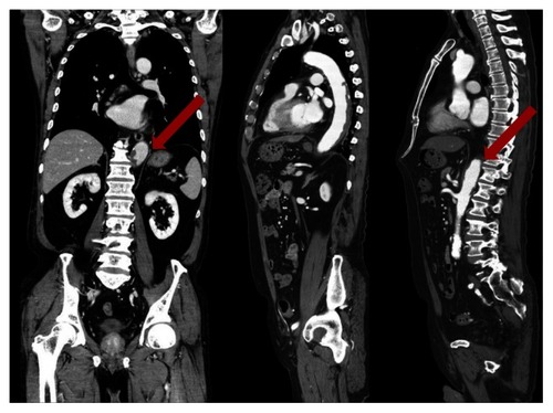 Figure 2 These images show abdominal computed tomography scans of longitudinal views at admission to our hospital.