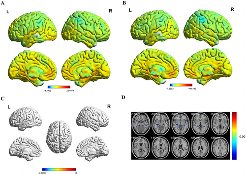 Figure 1 Spatial of distributions of FC patterns of the left hippocampus in HM patients and HCs.