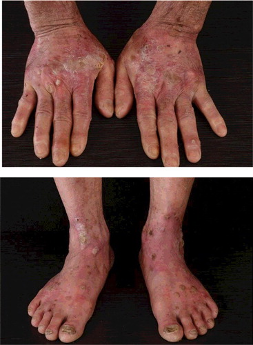 Figure 1. Arsenical keratosis lesions. Keratosis plaques, verruca-like keratoses and nails opacity on the dorsum of both hands and feet.