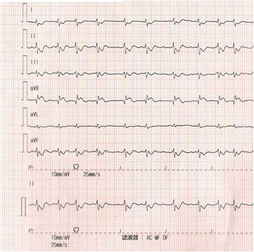 Figure 3 Electrocardiogram after resuscitation. Still atrial fibrillation, ST segment depression was significantly deepened and ST segment elevation in aVR lead.