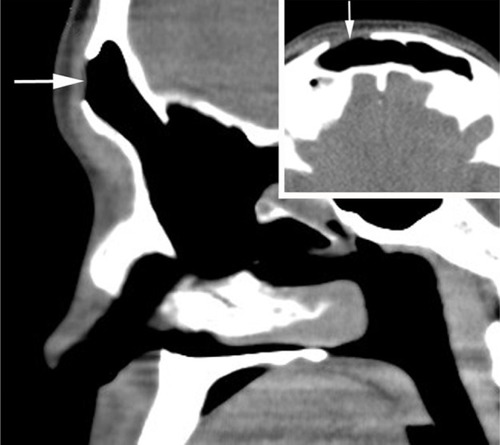 Figure 8 Postoperative CT image in the sagittal and axial plane.