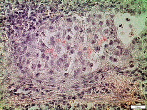 Figure 6. Human islet from a non-diabetic subject transplanted into the spleen of a nude mouse. Pronounced amyloid deposits had developed within the islet after 1 month. Congo red.