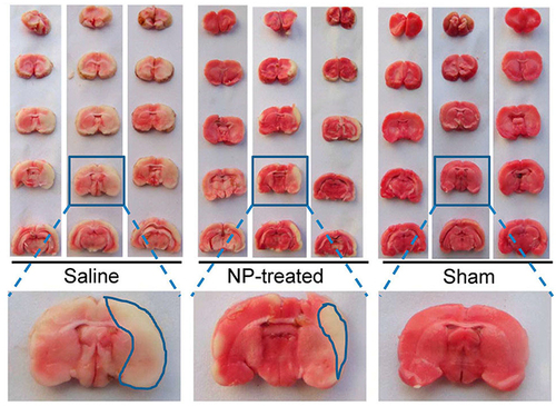 Figure 5 Comparison of the infarction area of 2,3,5-triphenyltetrazolium chloride-stained brain slices from different groups. Reprinted with permission from Liu Y, Ai K, Ji X et al. Comprehensive insights into the multi-antioxidative mechanisms of melanin nanoparticles and their application to protect brain from injury in ischemic stroke. J Am Chem Soc. 2017;139(2):856–862. Copyright (2017) American Chemical Society.Citation153