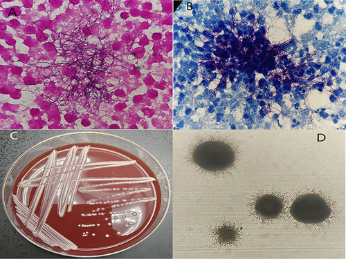 Figure 2 (A) Gram staining of the puncture fluid showed elongated, branching Gram- positive bacteria, with beaded filamentous structures; (B) The modified acid-fast staining showed acid-fast thin branching bacterium; (C) Small, dry, wrinkled pale yellow colonies appeared on the blood agar; (D) Examination of the colonies under a 10x objective lens showed abundant aerial hyphae on agar medium.
