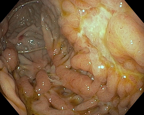 Figure 2 Upper gastrointestinal endoscopy showed suspicious ulcerated lesions along the large anterior gastric tuberosity, surrounded by a budding mucosa.