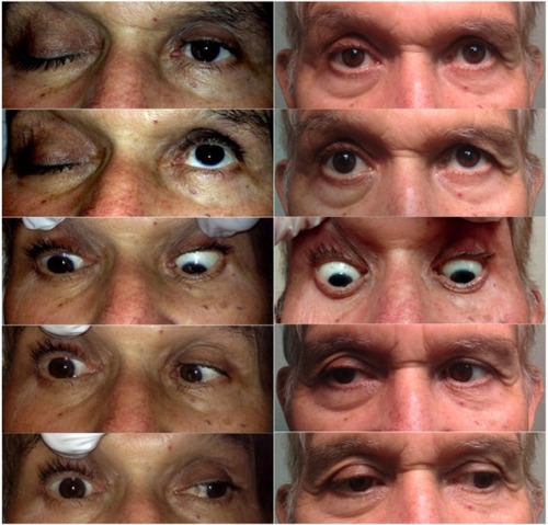 Figure 1 External examination of extraocular eye movements.