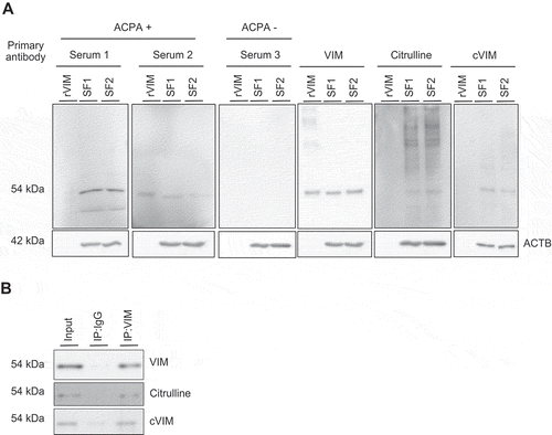 Figure 2. Detection of intracellular citrullinated antigens in synovial fibroblasts (SFs). Recombinant human VIM (rVIM) and SF lysates were immunoblotted using anti-citrullinated peptide antibodies (ACPA) positive or negative rheumatoid arthritis patient’s serum or anti-VIM, -citrulline or -citrullinated VIM (cVIM) antibody as a primary antibody (A). SF lysates were immunoprecipitated with anti-VIM antibody or normal goat IgG and blotted with anti-VIM, -citrulline or -cVIM antibody (B). IP, immunoprecipitation.