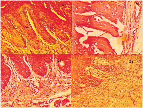 Figure 3. (X1) The group with no ligature (control). Rats without ligature showed healthy alveolar bone and cementum, and no sign of cell infiltration; (X2) the group with ligature-induced experimental periodontitis. Rats subjected to experimental periodontitis revealed inflammatory cell infiltration accompanied by cementum and alveolar bone destruction. (X3) The group with ligature-induced experimental periodontitis and treated with NEG without KP. Eugenol, as the oil phase, showed less significant effect on inflammatory cell infiltration and alveolar bone loss. (X4) The group with ligature-induced experimental periodontitis and treated with NEG with KP, showed significant effect on inflammatory cell infiltration and alveolar bone loss. D, dentin; PL, periodontal ligament; AB, alveolar bone; G,gingival tissue (hematoxylin and eosin staining, magnification 40×).