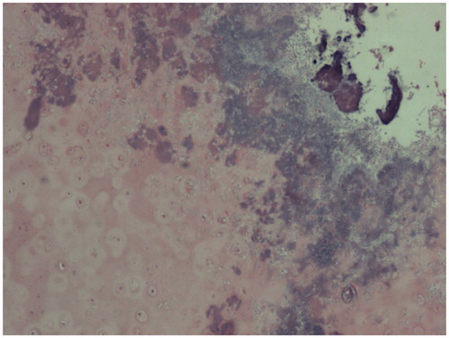 Figure 1. Fragments of cartilage with the edges showing colonies of bacteria and degenerative material [Haematoxylin & Eosin, 40× magnification].