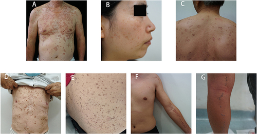 Figure 1 Clinical manifestations of the proband of two families and five sporadic cases. (A) Multiple, red-brown annular keratotic papules and plaques on the trunk and arms of the proband in families 1 with disseminated superficial porokeratosis (DSP); (B) Irregular annular and slightly elevated papules on the face of the proband in families 2 with disseminated superficial actinic porokeratosis (DSAP); (C–E) Multiple rounded hyperkeratotic plaques with central atrophy and peripheral ridging on the trunk of sporadic cases 1–3 with DSP; (F and G) Annular linear plaques on the limbs of sporadic cases 4–5 with linear porokeratosis (LP).