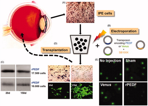 Figure 4. Gene therapy to treat neuroretinal degeneration. A) The anatomy of the human eye is shown. Image source: National Eye Institute, NIH. A small biopsy is taken from the patient’s iris for the isolation of ∼10.000 IPE cells that are taken in culture in an appropriate buffer. B) The IPE cells are electroporated ex vivo with components of the SB transposon system: a transposon carrying the therapeutic PEDF transgene or a Venus reporter and the SB100X transposase. C) Stable transfection and gene expression in primary human IPE cells. For the analysis of Venus reporter gene expression, human IPE cells were isolated post mortem, and taken in culture for four weeks before transfection with the transposon system components. For the analysis of PEDF expression, human IPE cells were isolated from donor tissue, and taken in culture for 8–12 weeks before transfection with the transposon system components. Expression of Venus (micrographs) and secretion of human PEDF (Western blot) at early (10 and 20 days) and late (150 days) indicate stable gene transfer and transgene expression. D) Genetically engineered IPE cells expressing and secreting human PEDF are grafted onto the patient’s retina. E) PEDF-transfected cells significantly reduced CNV in rats in vivo and corneal neovascularization in rabbits (Johnen et al., Citation2015; Kuerten et al., Citation2015). Shown here are retinal flat mounts of rats treated with laser to provoke CNV. Lesions are stained with FITC-conjugated isolectin B4 at day 14 post-transplantation. In non-injected (No Injection), sham-treated (Sham) animals and after transplantation of Venus-transfected cells (Venus) lesions are unaltered, whereas after transplantation with PEDF-transfected cells (rPEDF) lesion size was significantly reduced (see colour version of this figure at www.tandfonline.com/ibmg).