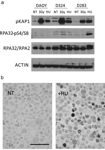 Figure 4. MBSC-like D283 cells show aberrant response to drug-induced replication stress. (a) Immunoblot analysis of the indicated DNA damage markers in the indicated three MB cell lines, under non-treated (NT), irradiated (one hour post 3Gy) and Hydroxyurea treated (HU) cells; Note the more robust Kap1 phosphorylation after irradiation in DAOY and D324 cells compared to the stem-like D283 cells, and particularly the hyperactive RPA Ser4/8 phosphorylation response to hydroxyurea (2 h, 2 mM) treatment in the D283 cells; NT – not treated. (b) Examples of immunoperoxidase staining patterns of RPA Ser4/8 phosphorylation in untreated and hydroxyurea treated D283 cells; Scale bar: 50 ◽m