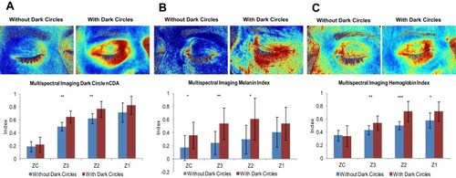 Figure 3 Multispectral analysis of the infraorbital zones including example images of (A) overall dark circle, (B) melanin, and (C) haemoglobin. (N =12 with dark circles versus N=12 without dark circles, *p<0.05, **p<0.01, ***p<0.001).