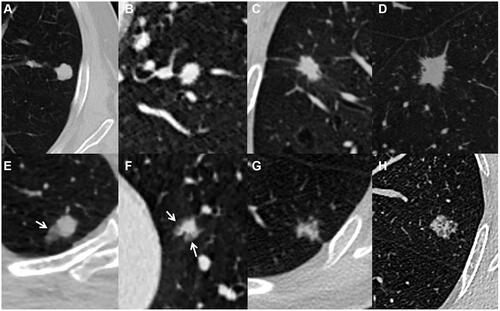 Figure 5 Solid cancerous nodules with smooth and lobulated margin (type Ia) (A), coarse margin (type Ib) (B), lobulated margin and sparse and long spiculations (type Ic) (C), intensive and short spiculations (type Ic) (D), well-defined peripheral patch locating at one side (arrow) (E) or surrounding lesion (arrows) (F) (type II), and heterogeneous density (type III) (G and H).
