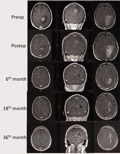 Figure 1. Illustrative case: 48 years old male admitted with complaints of cognitive decline and dizziness. Intracranial imaging showed a left paracentral lobule lesion where frozen section biopsy demonstrated glioblastoma and the patient underwent concurrent LITT. The patient received adjuvant treatment with radiation and temozolomide. Subsequently, the patient received monthly temozolomide maintenance doses. After 6 cycles, the patient returned back to work and reported no seizures or side effects. Overall, the patient completed 22 cycles of temozolomide and then treatment was discontinued. At the end of 6 years, MRI showed near total resolution of the lesion with minimal residual edema. The figure shows MRI images with T1 axial contrast-enhanced, T1 coronal contrast-enhanced and flair axial images from preoperative period to 36th month.