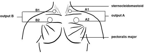 Figure 5 External diaphragm pacing.