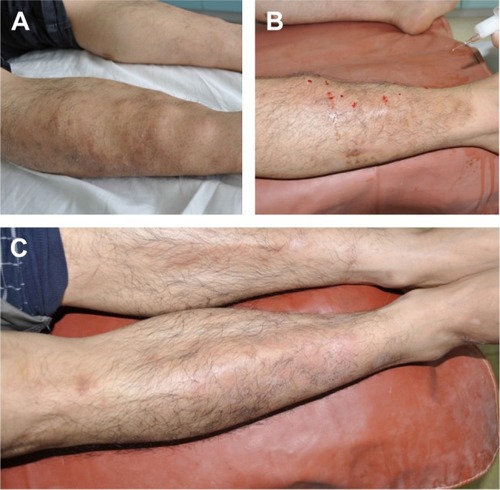 Figure 1 Nodular PTM treatment with compound betamethasone.