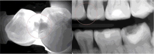 Figure 1. Caries lesion involving the enamel on teeth 24 and 25 visualized using near-infrared transillumination and X-rays.