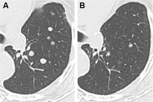 Figure 3 Chest computed tomography scans obtained (A) before and (B) after alectinib therapy.