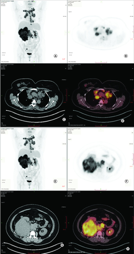 Figure 1. Whole body positron emission tomography-computed tomography before treatment.(A–D) Whole body PET-CT showed that enlarged hypermetabolic mediastinum lymph nodes(SUVmax:9.2). (E–H) Whole body PET-CT showed that a highly metabolic irregular mass in right kidney with heterogeneous density (120 mm*108 mm, SUVmax:15.2) and the border demarcation between the masses and the liver were indistinct.PET-CT: Positron emission tomography-computed tomography.