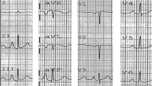 Figure 4 Electrocardiogram of a patient with emphysema.